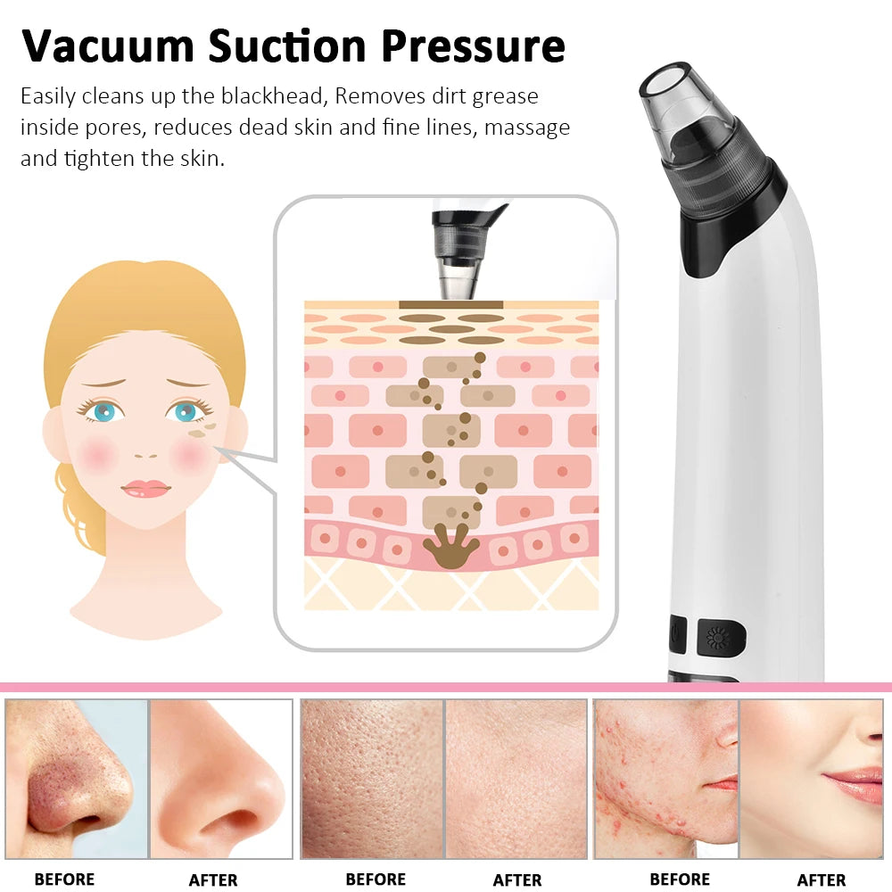 Blackhead Remover Electric Facial Cleansing Pore Vacuum Cleaner Ance Remover Pimple Face Cleaner Skin Scrubber Black Head Vacuum